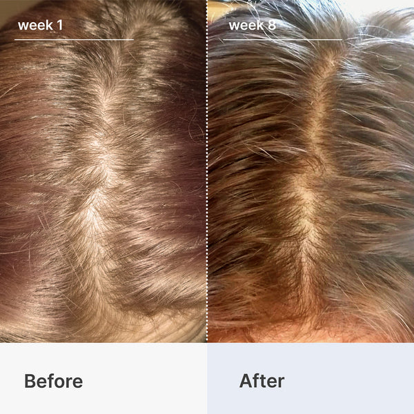 Hair Loss Starter Bundle