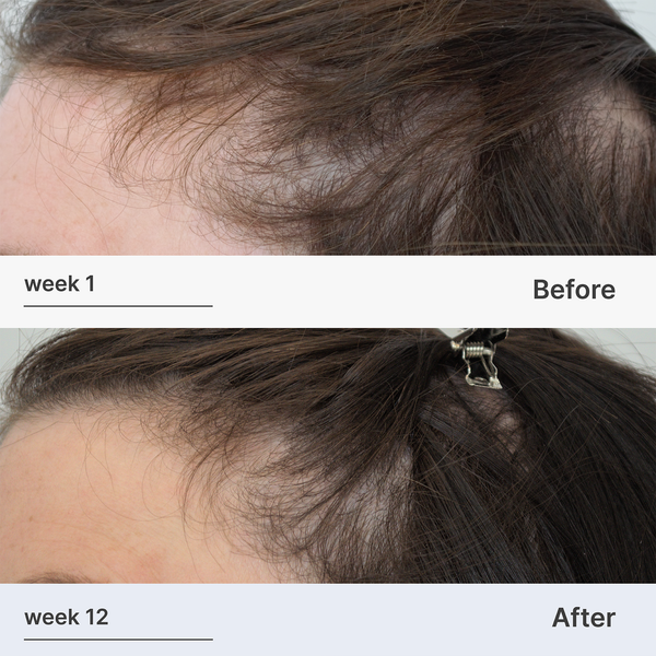 Superpower™ Thickening Hairpatches